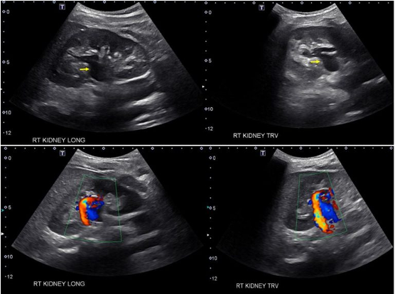 Intern Ultrasound of the Month: Hydronephrosis — University